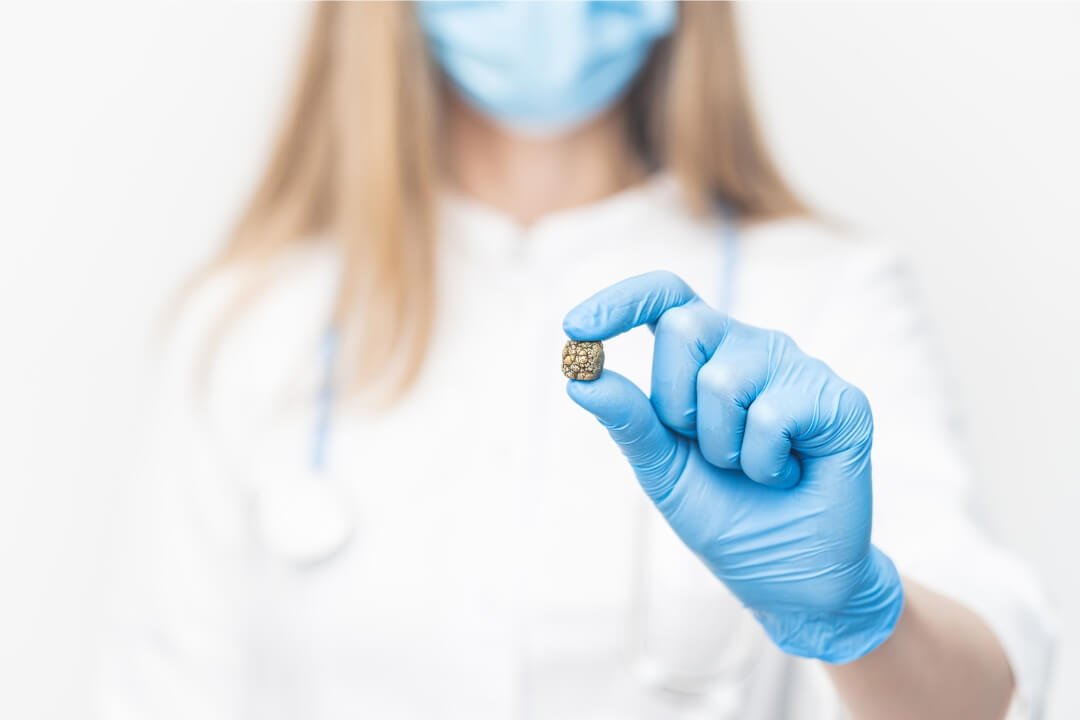 Colelitíase - Clínica Ultra Vaz - Ultrassom em Imperatriz