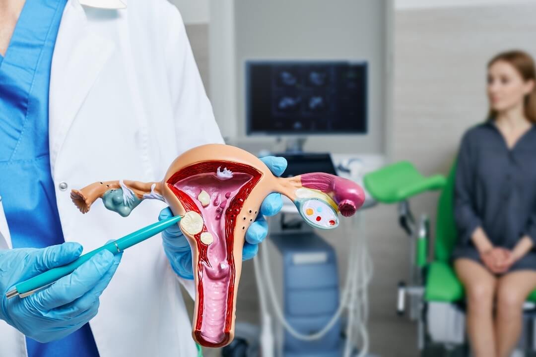 Mioma Uterino | Clínica Ultra Vaz - Ultrassom em Imperatriz