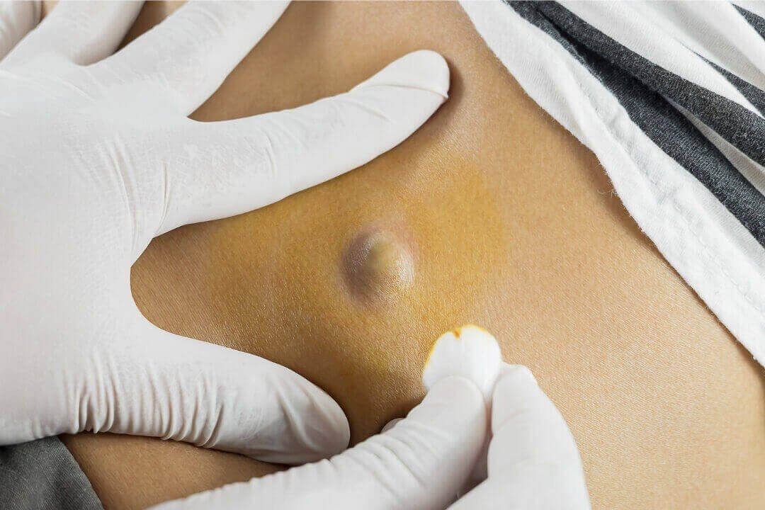 cisto epidermico clinica ultravaz ultrassom imperatriz Cisto Epidérmico | Clínica Ultra Vaz - Ultrassom em Imperatriz